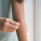 Braccio con eruzione cutanea pruriginosa, segno di febbre da stress.