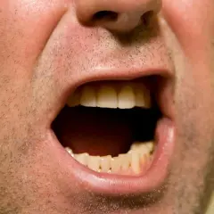 Bocca spalancata, denti visibili, sensazione di bocca secca ansia.