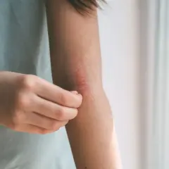 Braccio con eruzione cutanea pruriginosa, segno di febbre da stress.