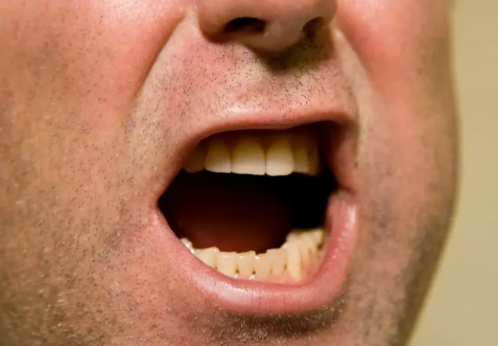 Bocca spalancata, denti visibili, sensazione di bocca secca ansia.