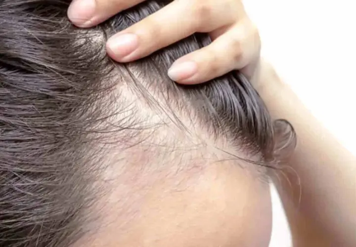 Dita che sfiorano la cute, evidenziando diradamento e sottili capelli. Un segno visibile di alopecia da stress.