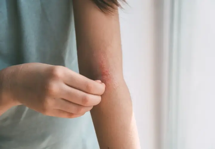 Braccio con eruzione cutanea pruriginosa, segno di febbre da stress.