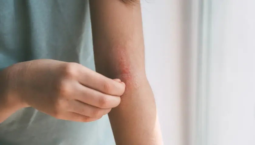 Braccio con eruzione cutanea pruriginosa, segno di febbre da stress.