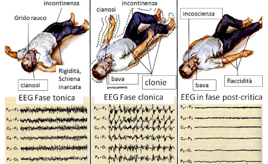 Crisi epilettica - Riconosci i segnali e agisci subito