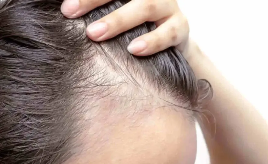 Alopecia da stress? Tempi, segnali e cosa controllare