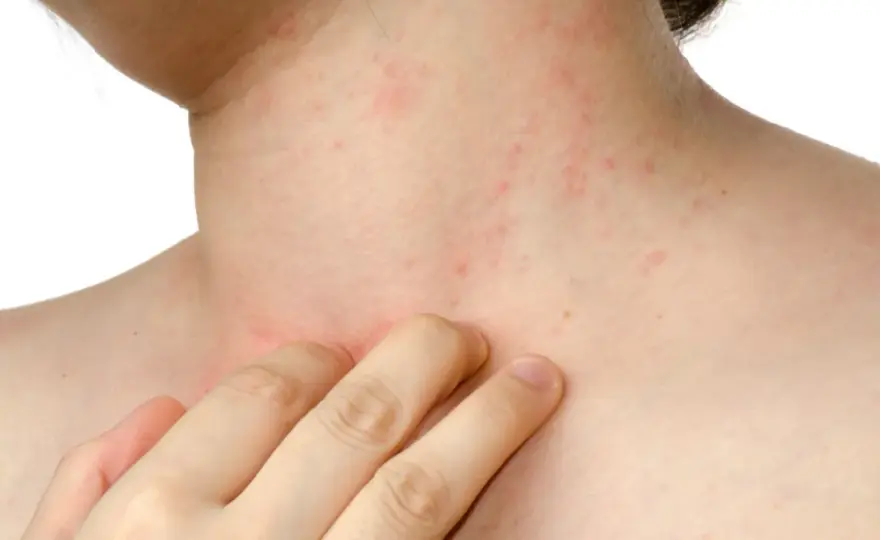 Dermatite da stress - Cosa fare e quando consultare un medico