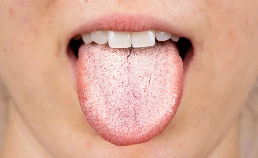Lingua bianca e ansia - quale legame c'è?