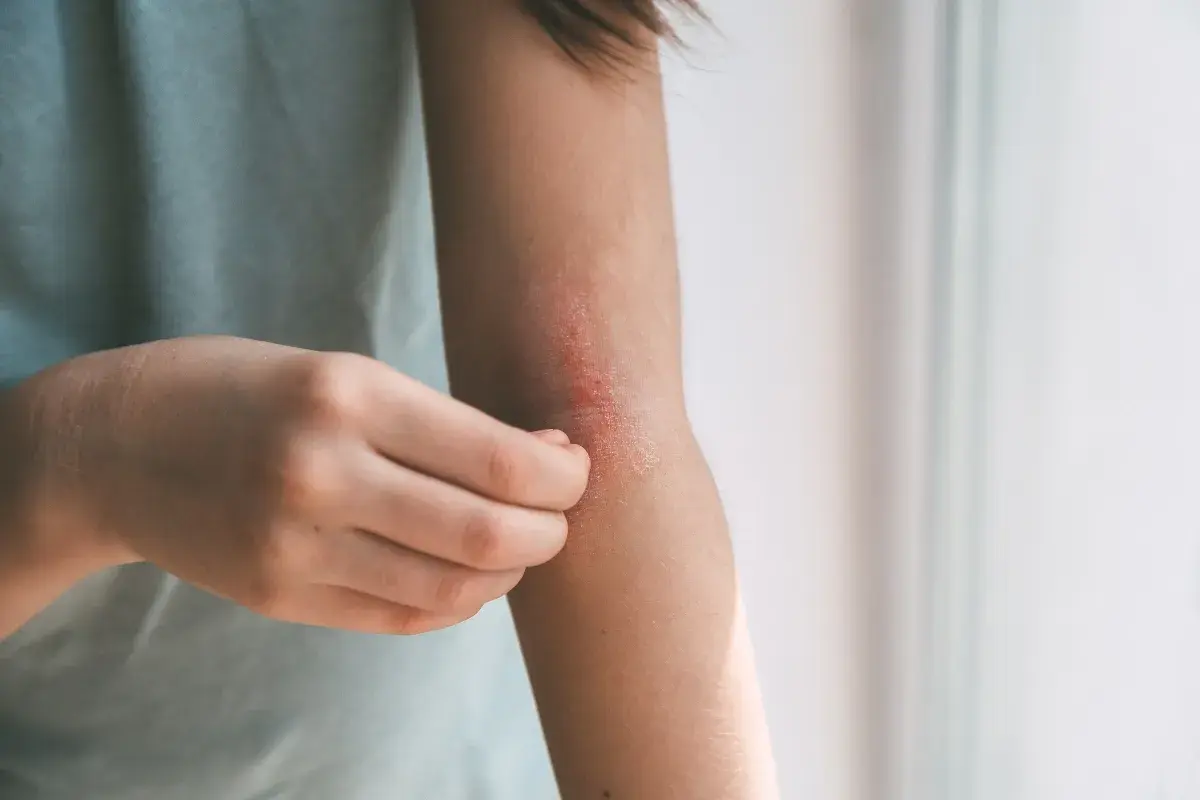 Braccio con eruzione cutanea pruriginosa, segno di febbre da stress.