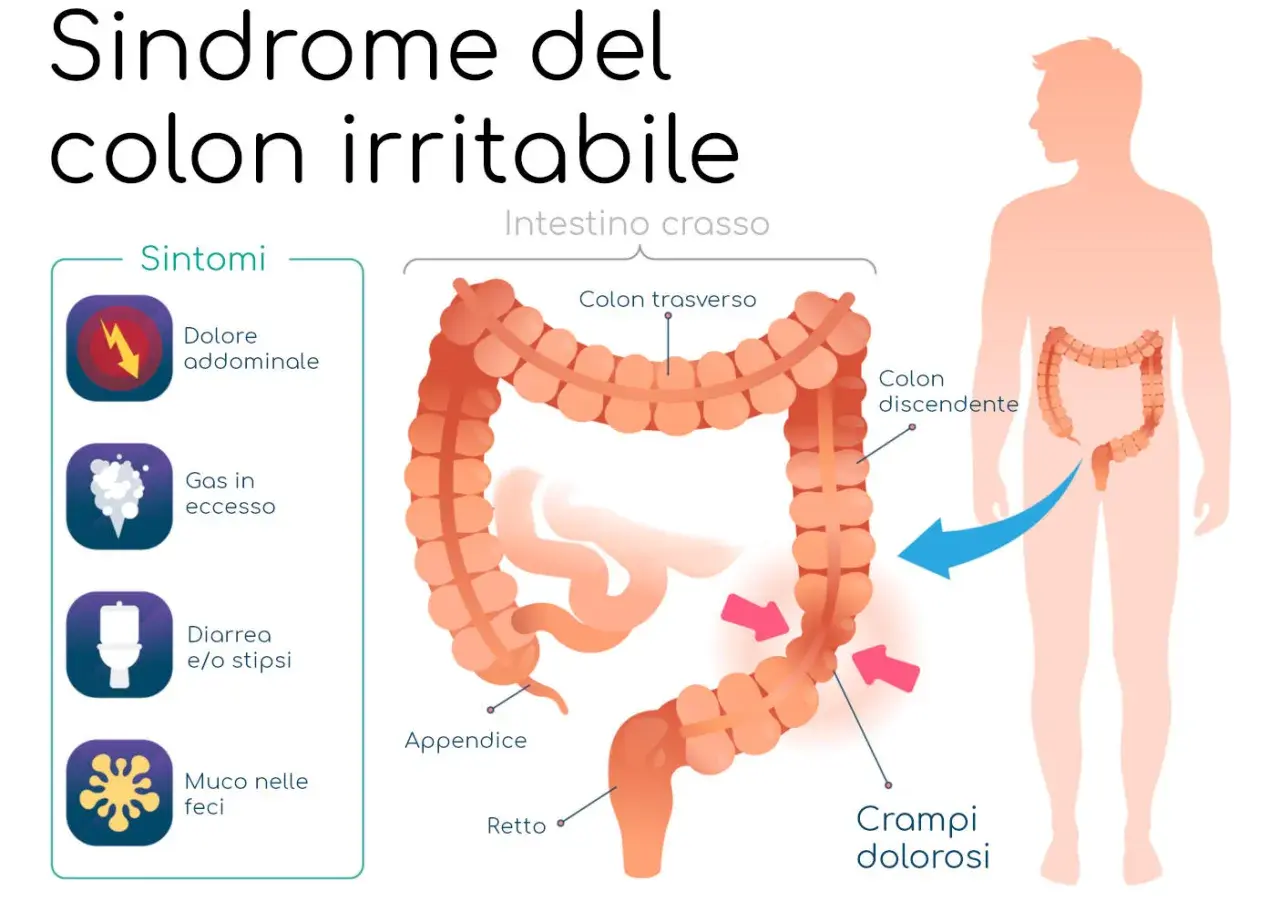 Illustrazione della sindrome del colon irritabile, con sintomi come dolore addominale, gas, diarrea/stipsi e muco. Evidenzia i crampi dolorosi.