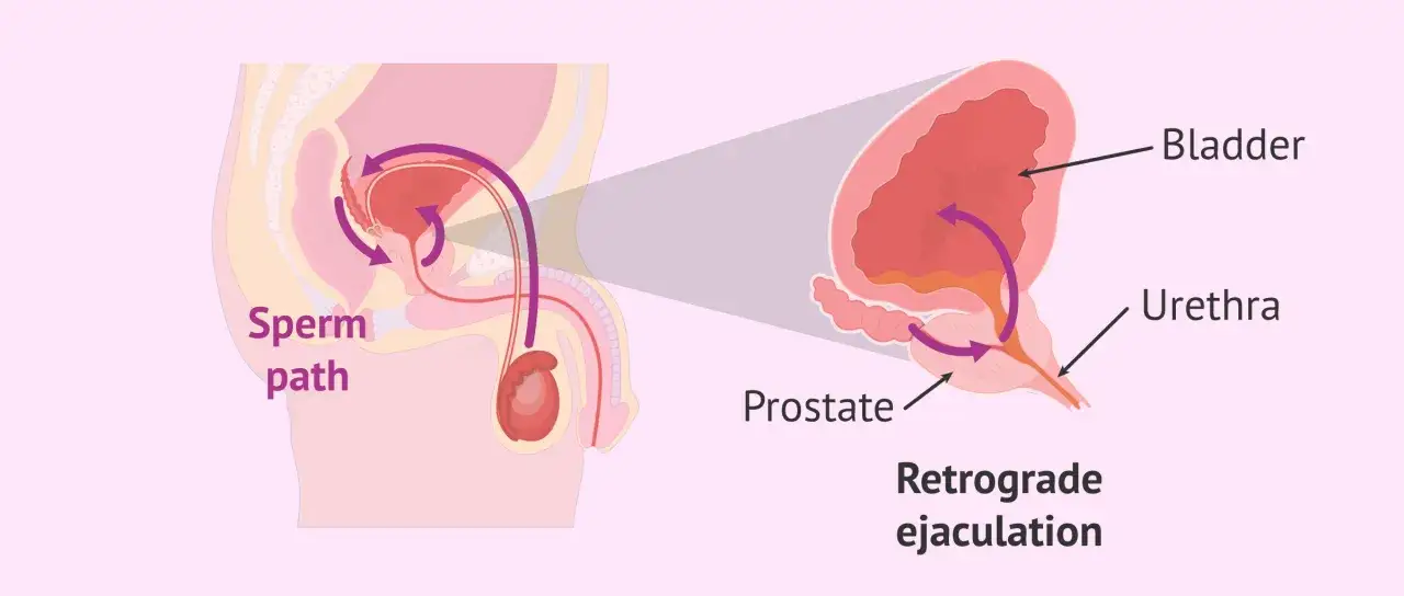Illustrazione anatomica del percorso dello sperma e dell'eiaculazione retrograda, che solleva curiosit&agrave; quando un uomo non viene.