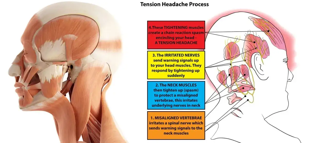Illustrazione anatomica del processo di cefalea tensiva: muscoli del collo e della testa contratti, nervi irritati e vertebre disallineate.